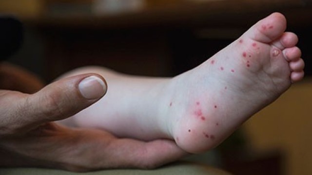 Image of a baby's foot with a rash